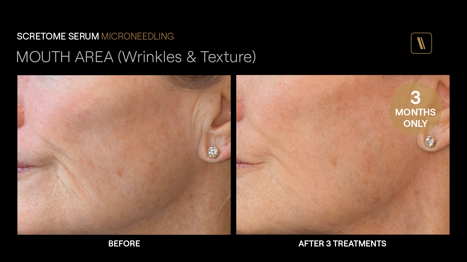BeforeAfter-BH