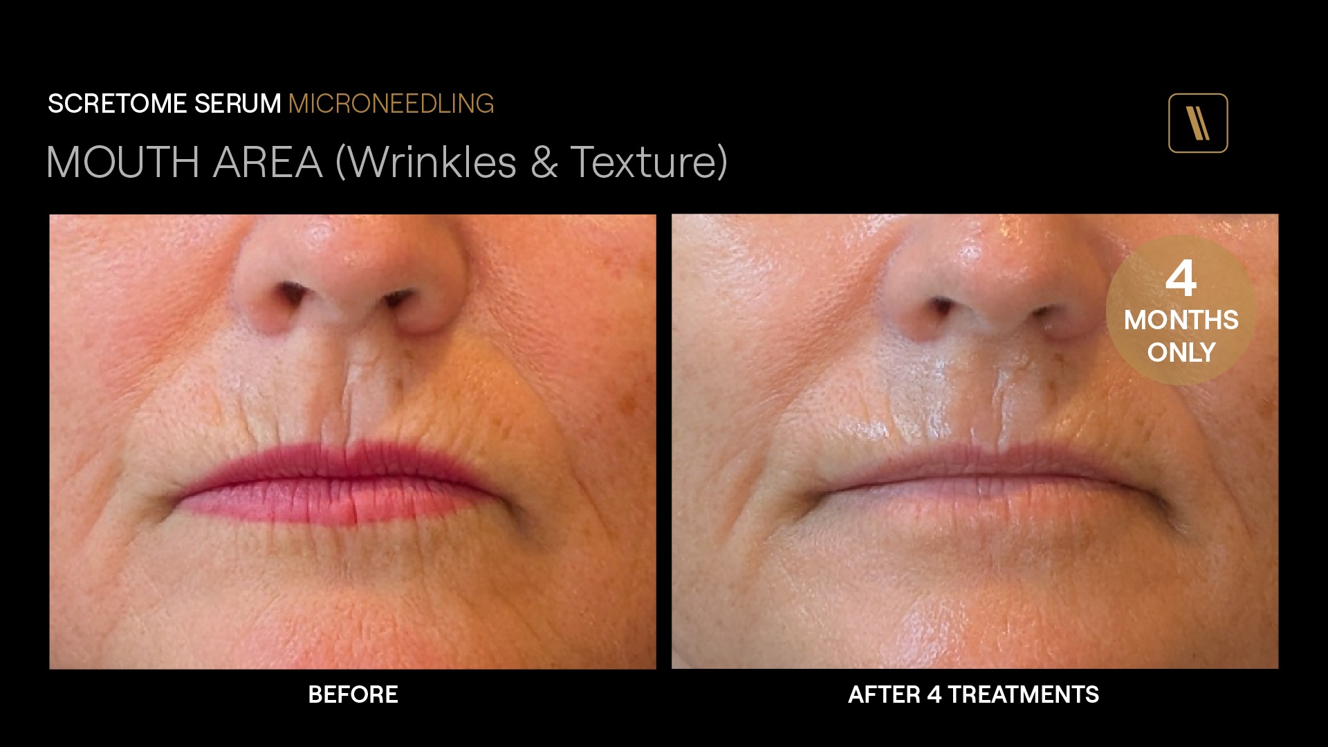 BeforeAfter-MP