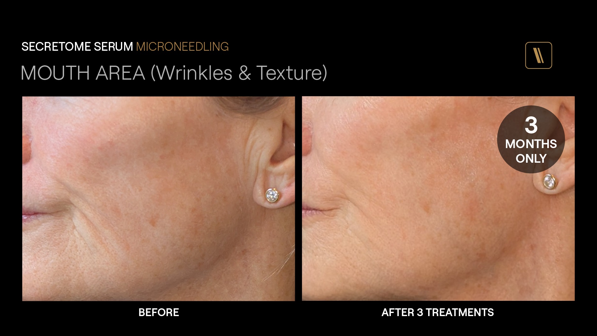 BeforeAfter-BH