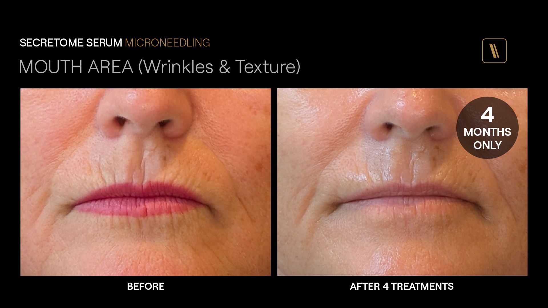 BeforeAfter-MP